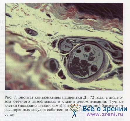 Морфологические изменения конъюнктивы при эндокринной офтальмопатии