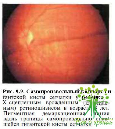 Х-сцепленный врожденный (ювенильный) ретиношизис
