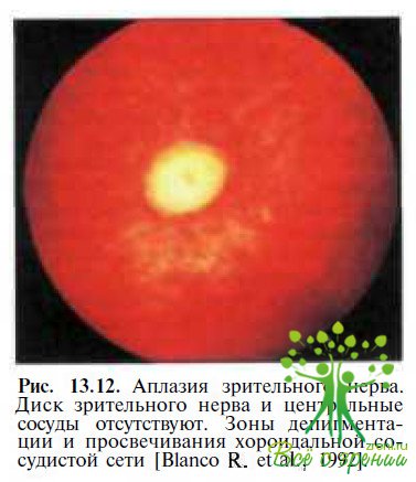 Аплазия зрительного нерва