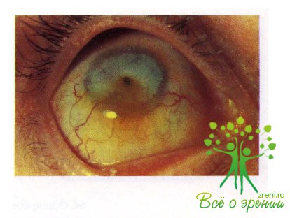 Атлас глазных болезней | Патология роговой оболочки и склеры (ЧАСТЬ 2)