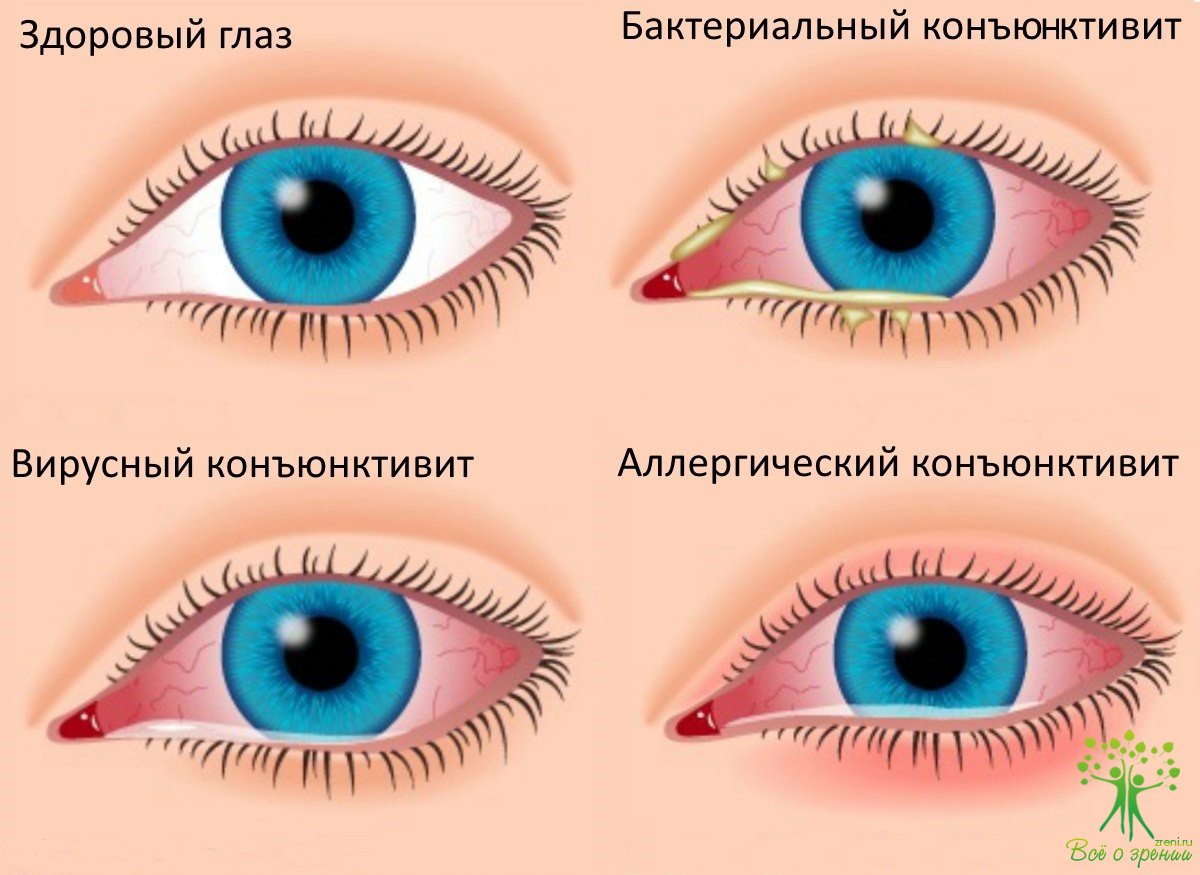 Воспалительные заболевания глаз (конъюнктивит, слезоточивость и др.)