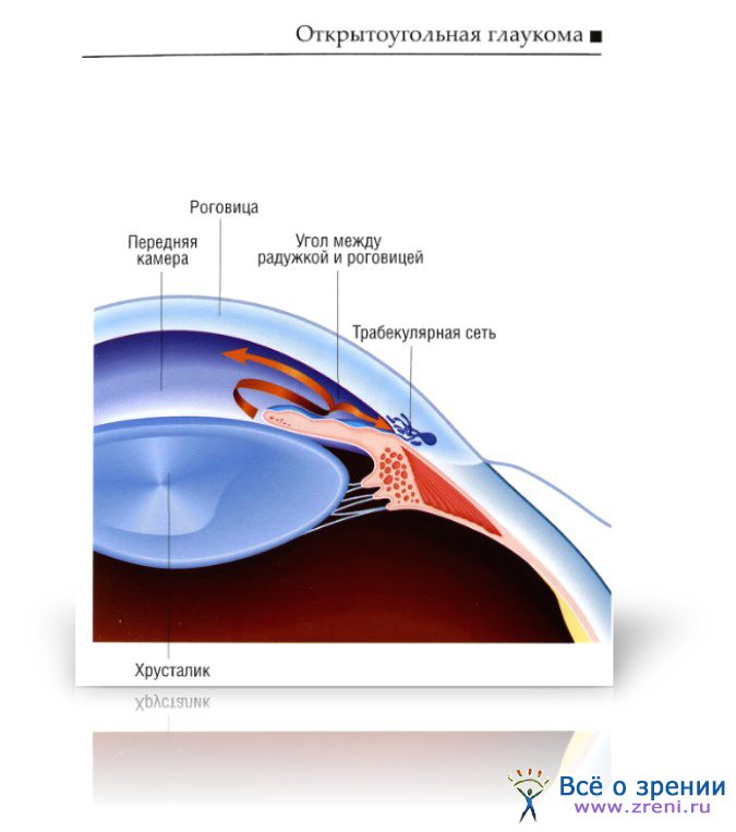 Для открытоугольной глаукомы характерны тест. Первичная открытоугольная глаукома. Первичная открытоугольная глаукома 3а. Эпидемиология открытоугольная глаукома. Открытоугольная глаукома стадии.
