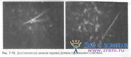 Конфокальная лазерная сканирующая микроскопия роговицы