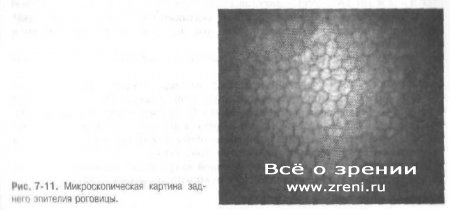 Конфокальная сканирующая микроскопия роговицы