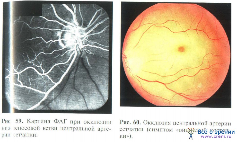 Передняя ишемическая нейропатия. Окклюзия центральной артерии сетчатки клиника. Эмболия центральной артерии сетчатки глаза. Тромбоз ЦВС глазное дно. Глазное дно тромбоз артерии.