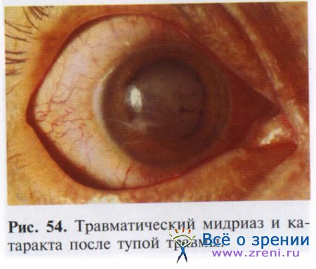 Разрыв радужной оболочки глаза лечение
