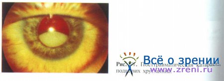 Повреждение роговицы и хрусталика глаза лечение