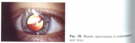 Травма хрусталика глаза вывих хрусталика