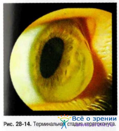 Изменение формы роговицы глаза