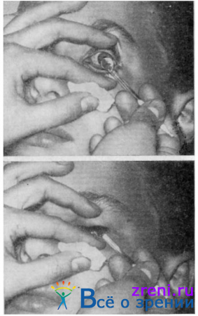 Удаление инородных тел с конъюнктивы и роговицы ватным тампоном