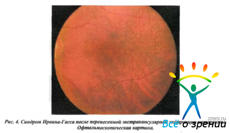 Кистозный отек глаза лечение