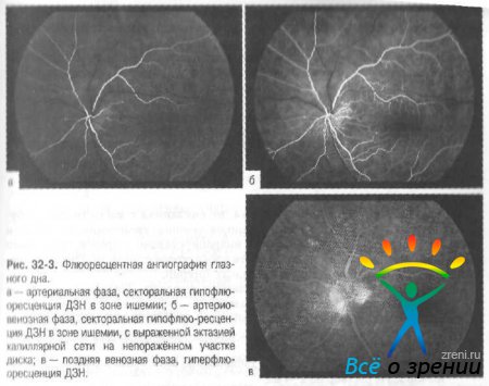 Код мкб ишемическая нейропатия зрительного нерва