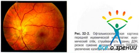 Нейропатия глаза код по мкб thumbnail