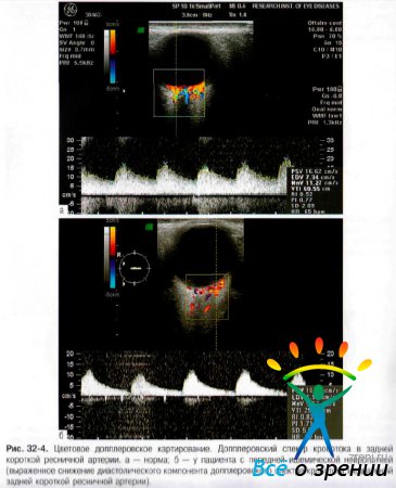 Ишемическая нейропатия зрительного нерва код мкб thumbnail