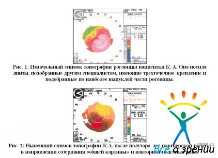 Топография роговицы пациентки К.А.