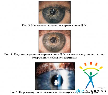 Результаты кератоскопии до и после лечения кератоконуса