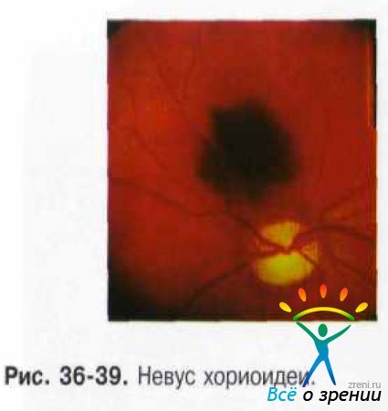 Код мкб меланома хориоидеи глаза