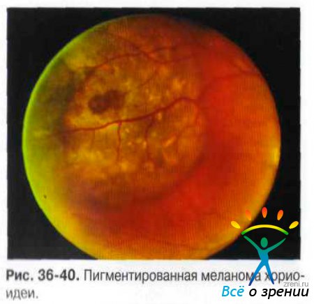 Меланома сосудистой оболочки глаза код мкб