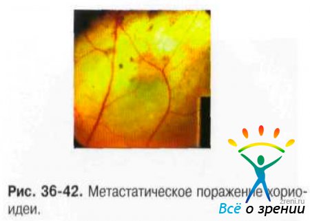 Меланома сетчатки глаза код мкб