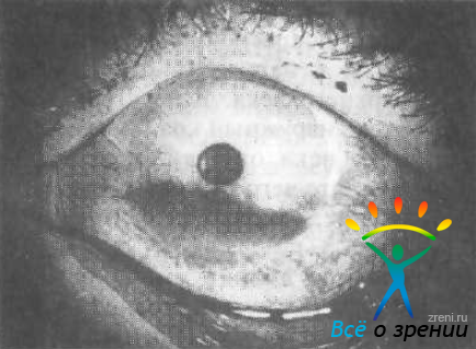 Синдром «сухого глаза» (роговично-конъюнктивальный ксероз)