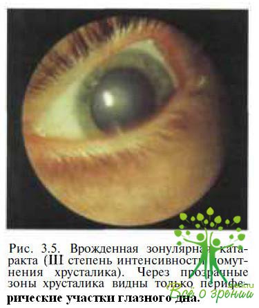 Клинические и электрофизиологические особенности двусторонних врожденных катаракт