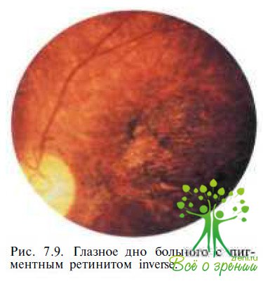 Атипичные формы пигментного ретинита