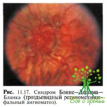Рацемозный ретиномезэнцефальный ангиоматоз (синдром Бонне — Дешама — Бланка или Вайберна- Мэйсона)