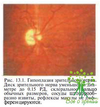 Гипоплазия зрительного нерва