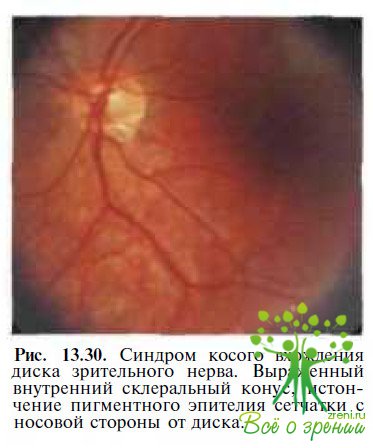 Синдром косого вхождения диска зрительного нерва