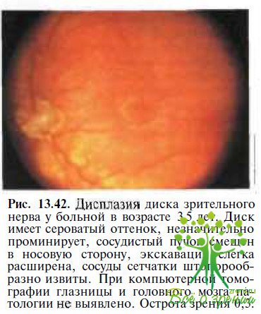 Дисплазия сетчатки глаза у взрослого человека thumbnail