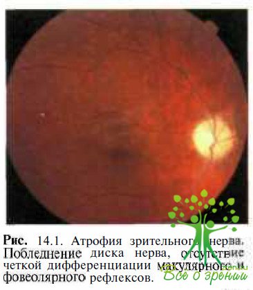 Аутосомно-доминантная атрофия зрительного нерва