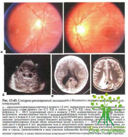 Дисплазия сетчатки глаза у взрослого человека
