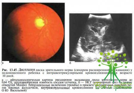 Дисплазия сетчатки глаза у взрослого человека