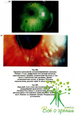 Диагностика ранней врожденной глаукомы основана на данных