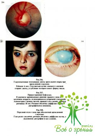 Диагностика ранней врожденной глаукомы основана на данных thumbnail