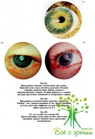 Диагностика при врожденной глаукоме