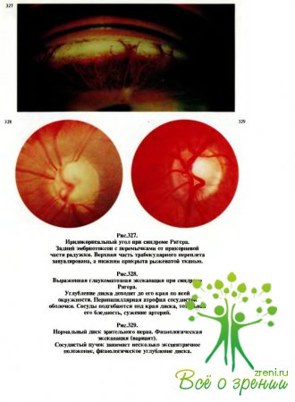 Ранняя диагностика врожденной глаукомы