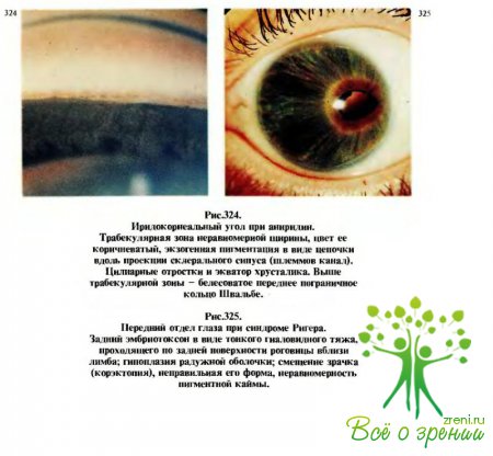 Диагностика при врожденной глаукоме
