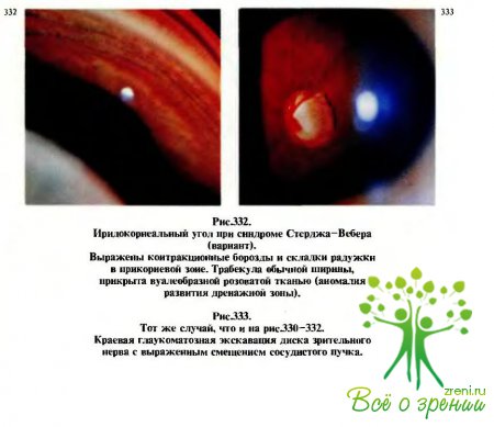 Диагностика ранней врожденной глаукомы основана на данных