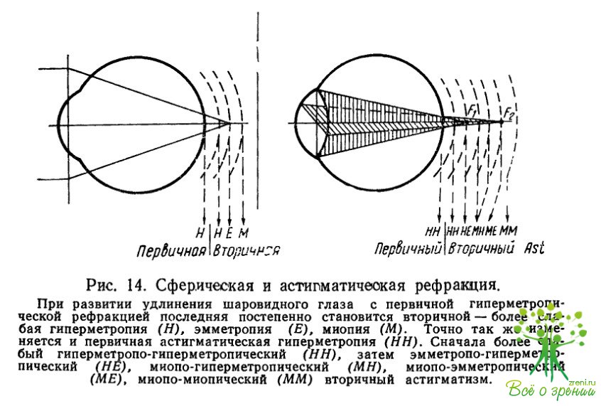 Что такое сложный миопический астигматизм. Обратный миопический астигматизм. Сложный обратный гиперметропический астигматизм. Миопический астигматизм h52.2 что это. Сложный миопический астигматизм правого глаза.