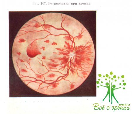Глазное дно при анемии