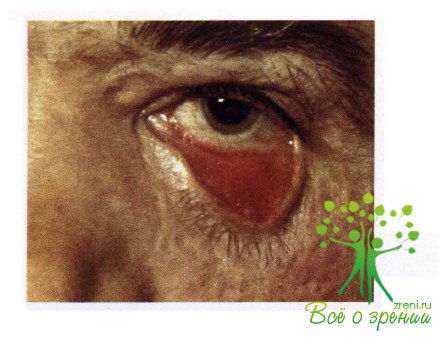 Атлас глазных болезней | Патология век и соединительной оболочки глаза