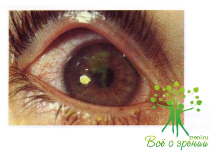 Атлас глазных болезней | Патология роговой оболочки и склеры (ЧАСТЬ 1)