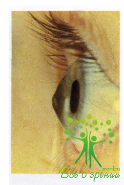 Атлас глазных болезней | Патология роговой оболочки и склеры (ЧАСТЬ 3)