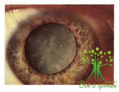 Атлас глазных болезней | Патология хрусталика и стекловидного тела