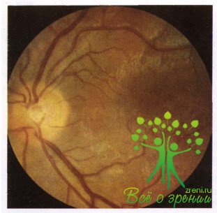 Атлас глазных болезней | Патология сосудистого тракта глаза
