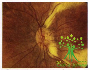 Атлас глазных болезней | Патология сетчатой оболочки