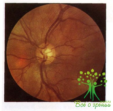 Атлас глазных болезней | Патология диска зрительного нерва