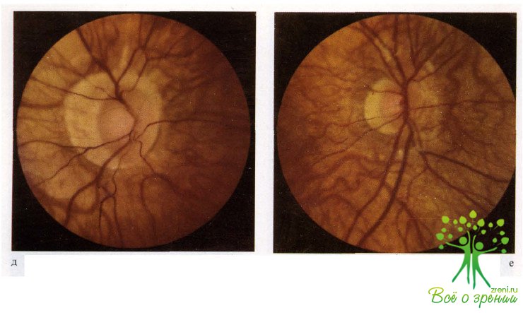 Аномалия развития зрительного нерва. Колобома зрительного нерва. Врожденные аномалии сосудистой оболочки глаза. Аномалии зрительного нерва глаз.