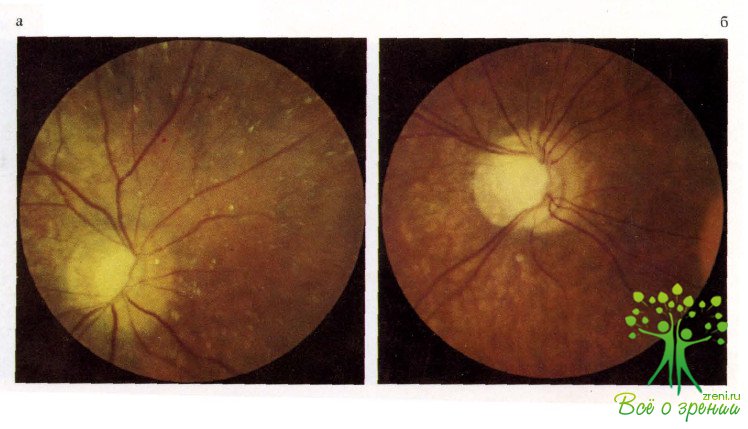 Аномалия развития зрительного нерва. Патологии зрительного нерва глаукома. Колобома зрительного нерва. Колобома диска зрительного нерва.